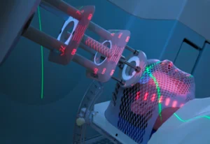 ακτινοθεραπεια