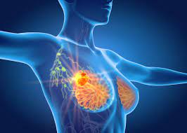 Ο στόχος της ακτινοθεραπείας στη νέα εποχή